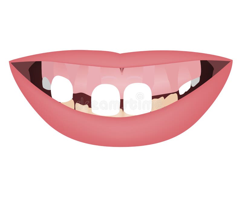 Kids jaws with gummy smile, crooked lower teeth and distal bite before the orthotropics or orthotropics treatment. Vector illustration stock illustration