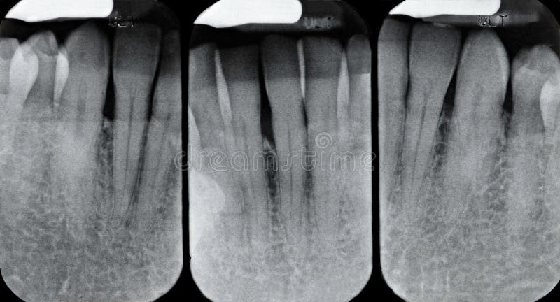Lower Periodontal X-rays. X-rays revealing periodontal disease of the gum and bone. Desaturated color image stock photo