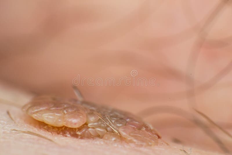 Macro photo of a skin wart, papilloma virus infection. C royalty free stock photo