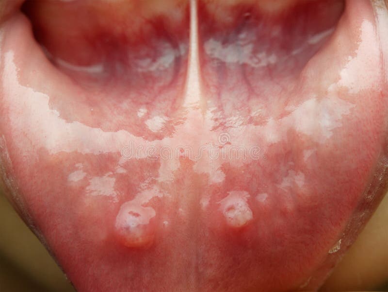 Macro shot of aphtha disease of a kid or child.  stock image