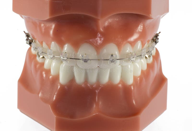 Model of Teeth with Clear Ceraminc Braces stock images