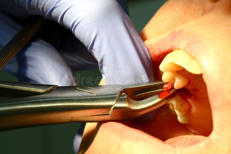 Molar tooth extraction with dental pliers. Done under anaesthesia royalty free stock photography