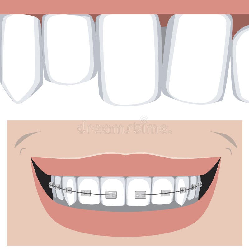 Molars and incisors with braces on the upper jaw healthy smile, flat vector stock illustration with teeth and as a concept of. Crooked molars and incisors with royalty free illustration