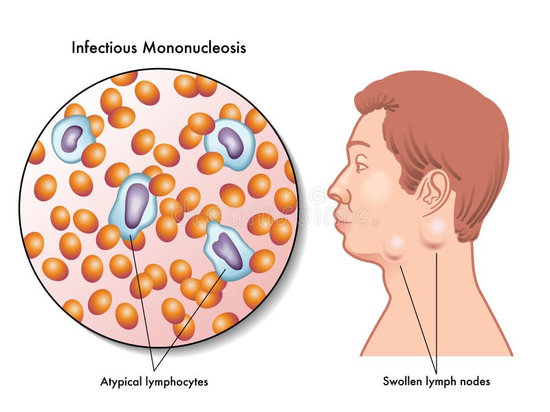 mononucleosis royalty free illustration