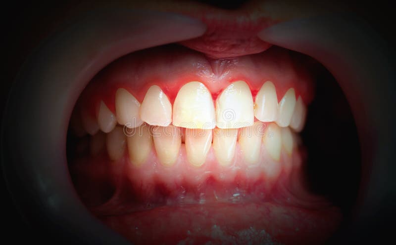 Mouth with bleeding gums on a dark background royalty free stock image