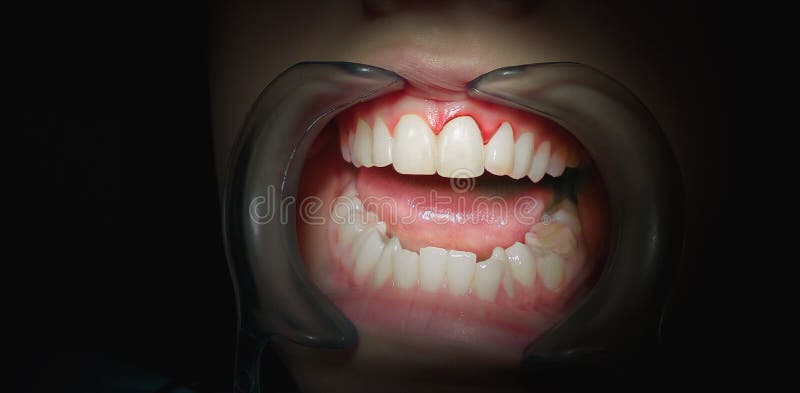 Mouth with bleeding gums on a dark background. stock photo