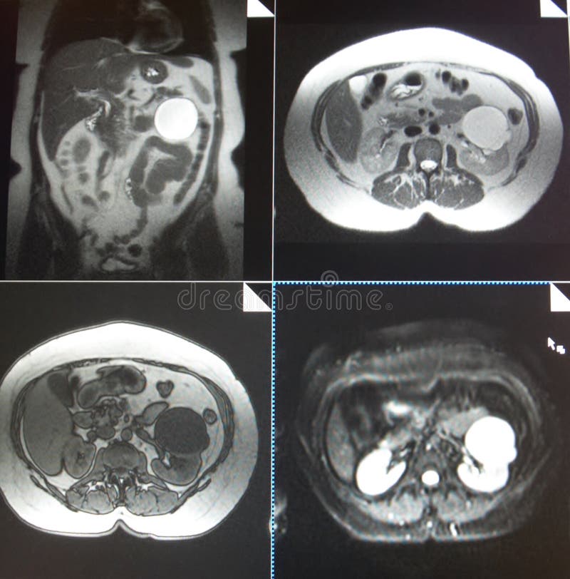 Mri of renal cyst. The basis of modern medicine is modern diagnostic with possibilities to show area of pathology in different positions and anatomical stock image Mri of renal cyst. The basis of modern medicine is modern diagnostic with possibilities to show area of pathology in different positions and anatomical stock image