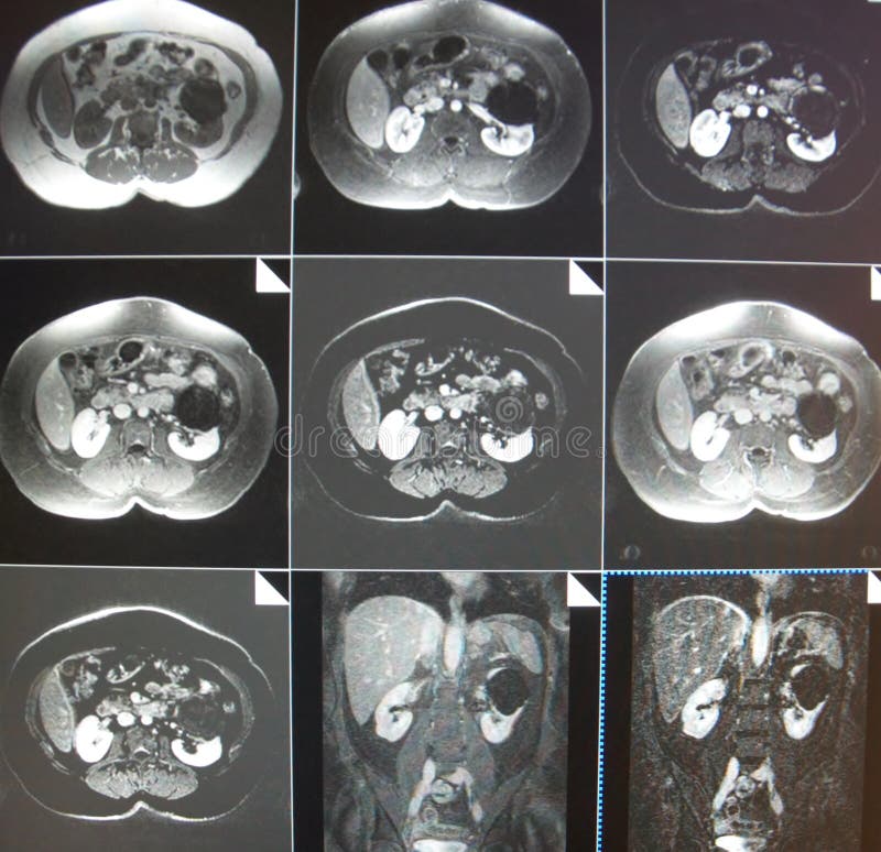Mri of kidney cyst. The basis of modern medicine is modern diagnostic with possibilities to show area of pathology in different positions and anatomical stock images Mri of kidney cyst. The basis of modern medicine is modern diagnostic with possibilities to show area of pathology in different positions and anatomical stock images