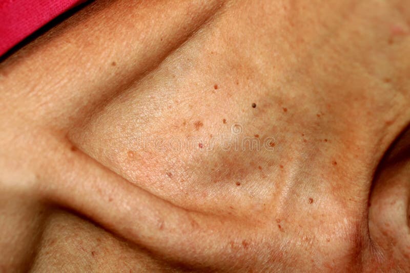 Neck and collarbone in papillomas. Papilloma on the skin. Neck and collarbone in papillomas. Papilloma on the skin stock photo