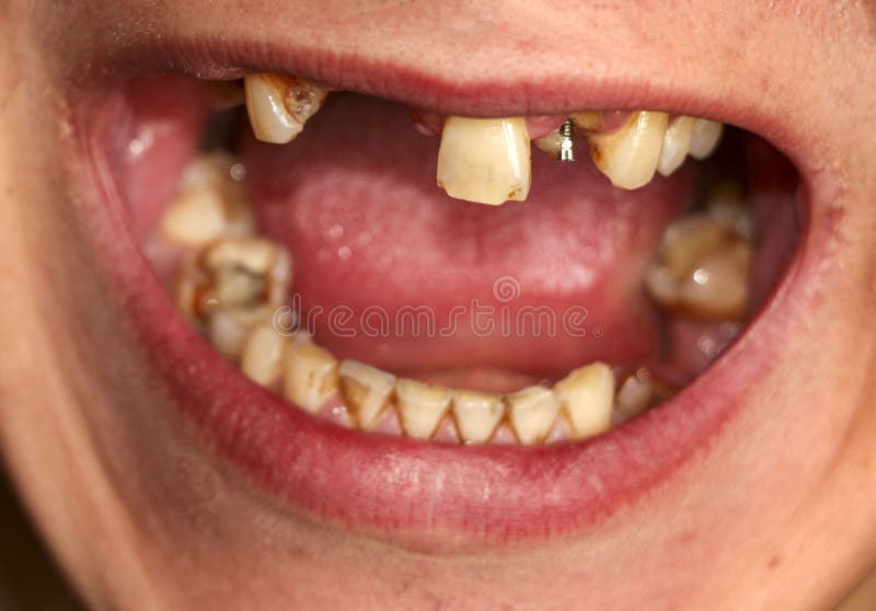 Open mouth with broken, diseased teeth affected by caries and periodontitis. Steel pin in the gum for the installation of a dental. Open mouth with broken stock photo