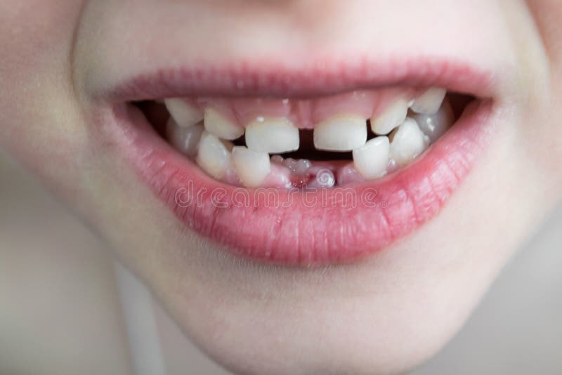 The open mouth of the child. Two rows of teeth. In the bottom row fell out two milk teeth. Growing an adult tooth. royalty free stock photography