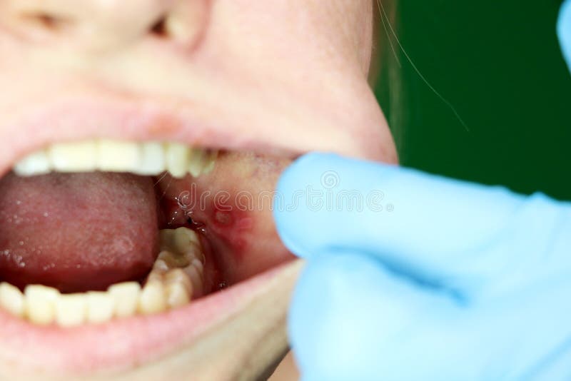Painful ulcer and stomatitis on the mucous cheek of a girl. After the operation to remove the wisdom teeth. Stitches and. After the operation to remove the stock images