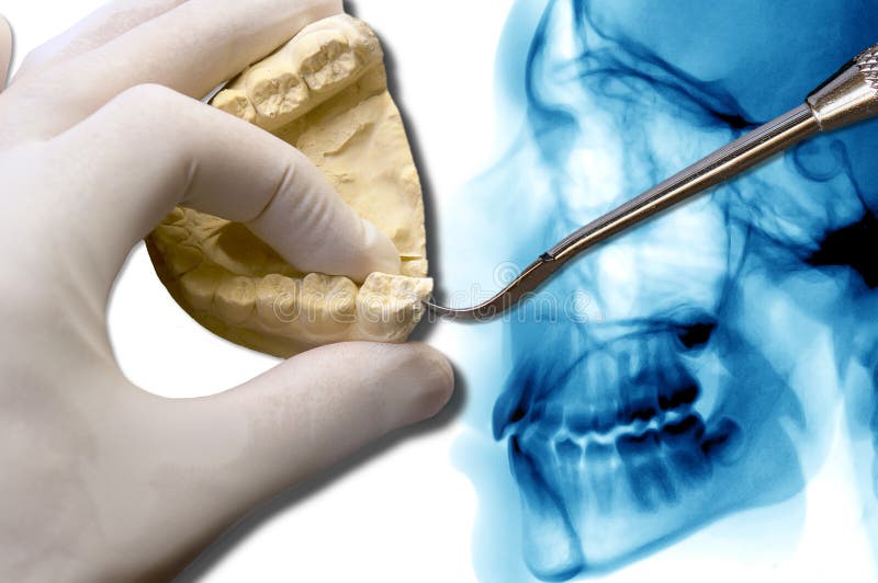 Orthodontics tool show molar tooth over x-ray. Orthodontics tool show molar tooth over dental scan ct royalty free stock photography