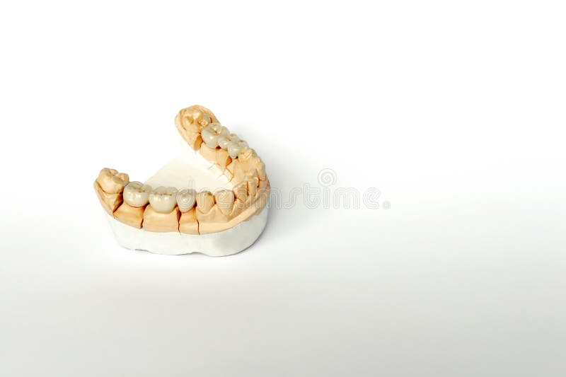 Orthopedic dentistry. tooth replacement concept. dental prosthetics. cermet teeth. ceramic bridges. gypsum model of the jaw and. Teeth. White background royalty free stock images