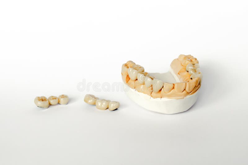 Orthopedic dentistry. tooth replacement concept. dental prosthetics. cermet teeth. ceramic bridges. Gypsum model of the jaw and teeth. White background stock photos