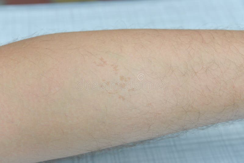 Over time, moles and other spots grow on the skin stock image