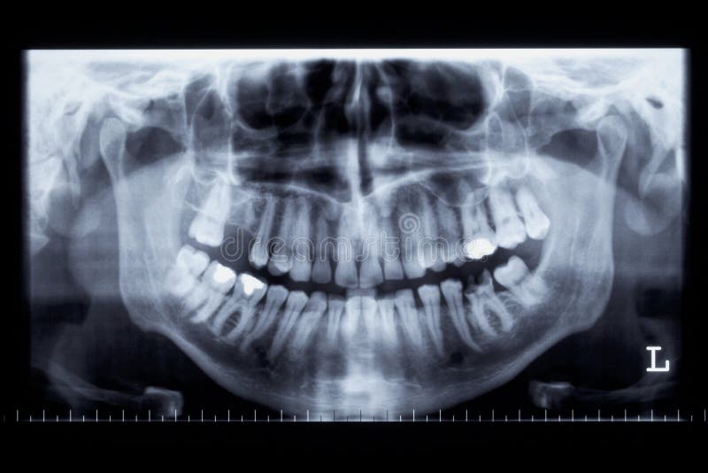Panorama x-ray image of a human jaw royalty free stock image