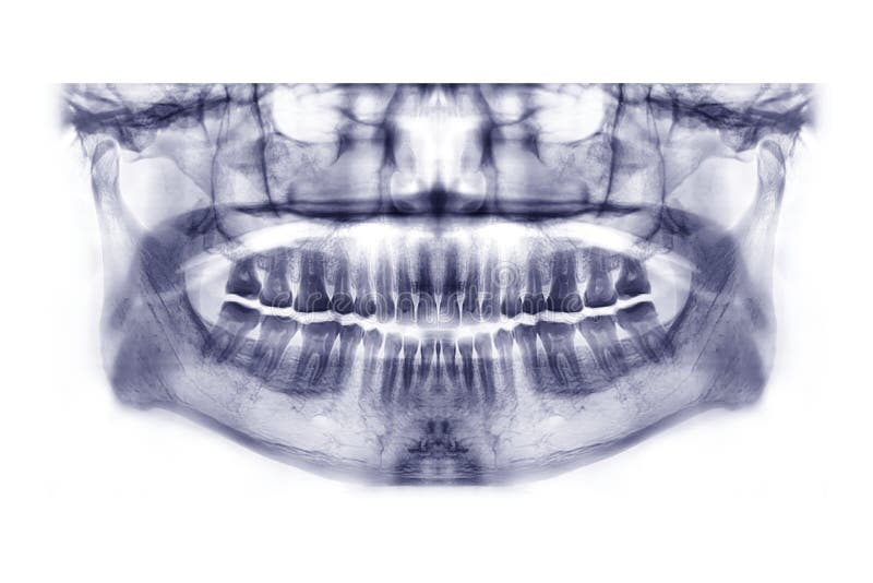 Panoramic dental x-ray image or orthopantomogram royalty free stock images