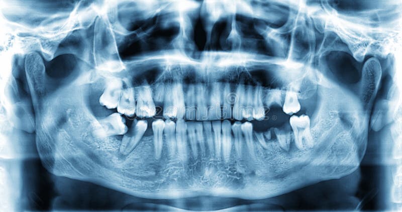 Panoramic dental x-ray image of teeth stock image