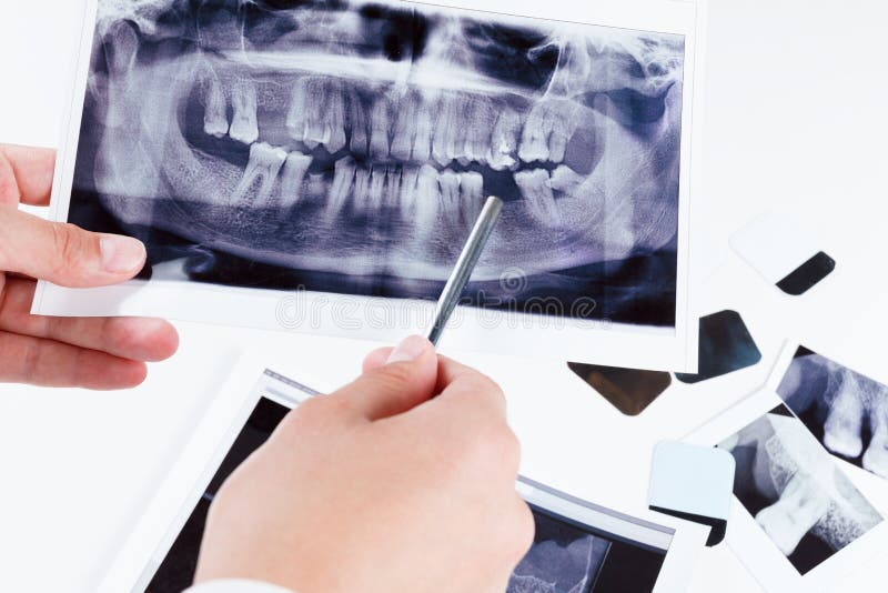 Panoramic dental x-ray image of teeth. royalty free stock image