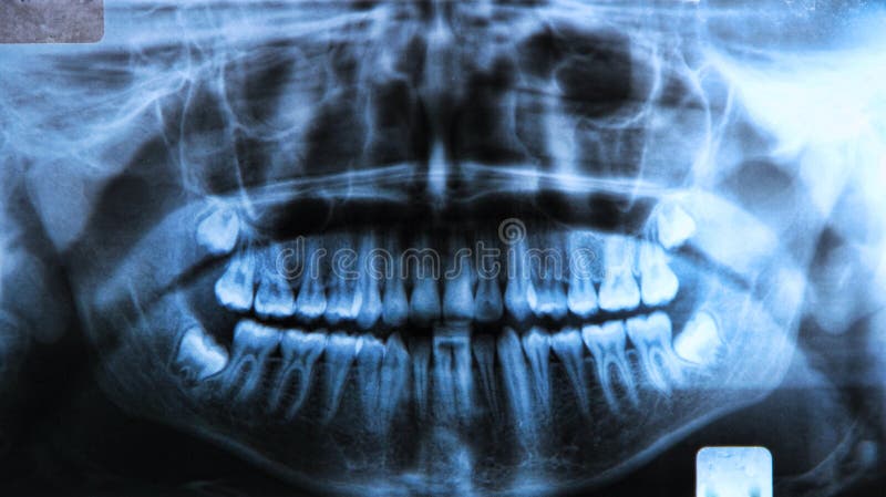 Panoramic dental x-ray stock photography