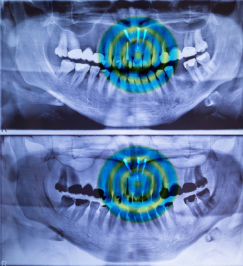 Panoramic dental X-ray picture in 2 versions with pain image of the frond teeth stock images