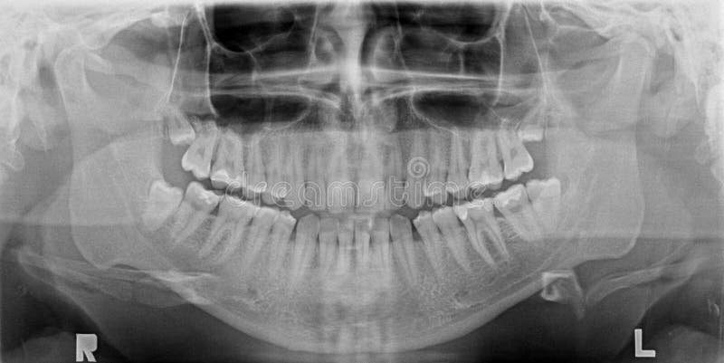 Panoramic x-ray image of teeth royalty free stock photos