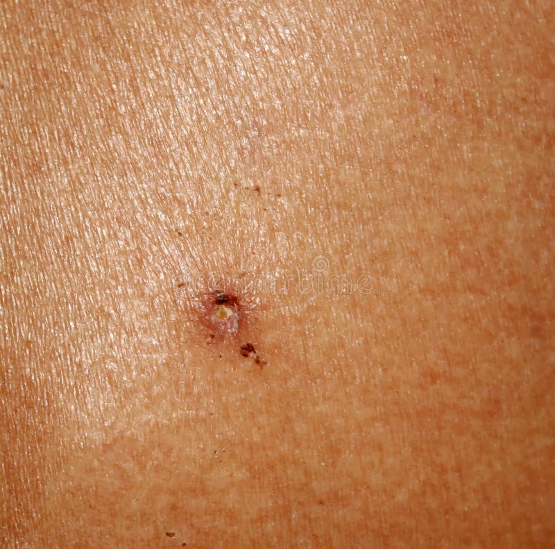 Papilloma birthmark on the skin. Treatment papillomy acid. Papilloma birthmark on the skin. Treatment papillomy acid royalty free stock photography