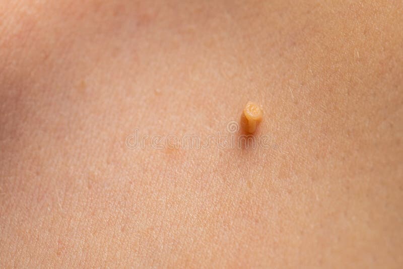 Papilloma on human skin. Close up picture of papilloma on human skin. Wart. Dermatological problem stock photo