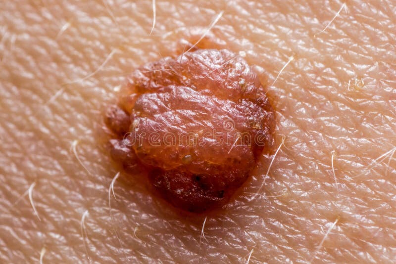 Papilloma mole on human skin macro shot, concept of health, skin care and cancer risk. Papilloma mole on human skin, macro shot, concept of health, skin care and royalty free stock photos