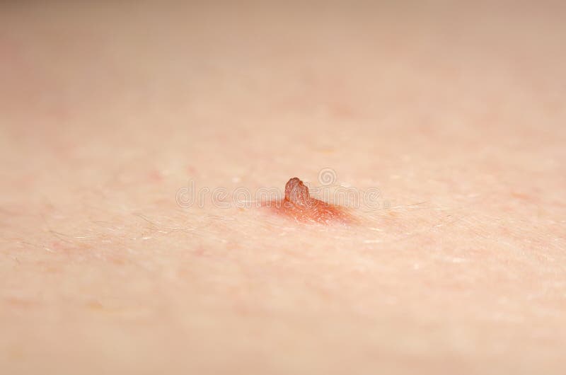 Papilloma nevus or mole on human skin. Papilloma nevus or mole on the human skin stock photography