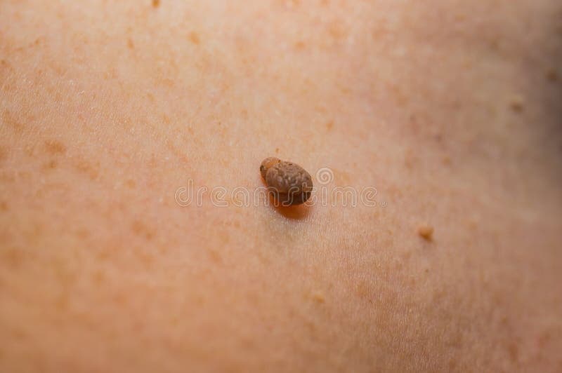 Papilloma on the skin of a woman’s neck. Soft focus, shallow depth of field.  stock photos