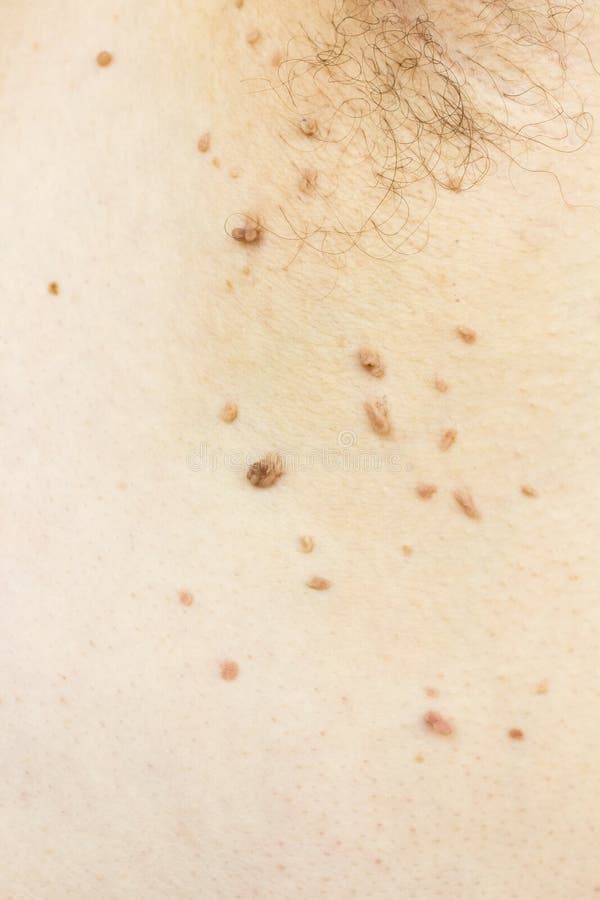 Papilloma virus in the armpit of a man, a dermatological problem, the concept of skin disease.  royalty free stock photography