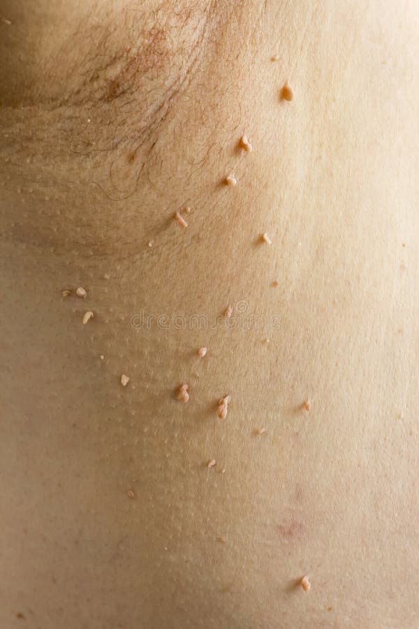 Papilloma virus in the human armpit, the concept of skin disease.  stock photos