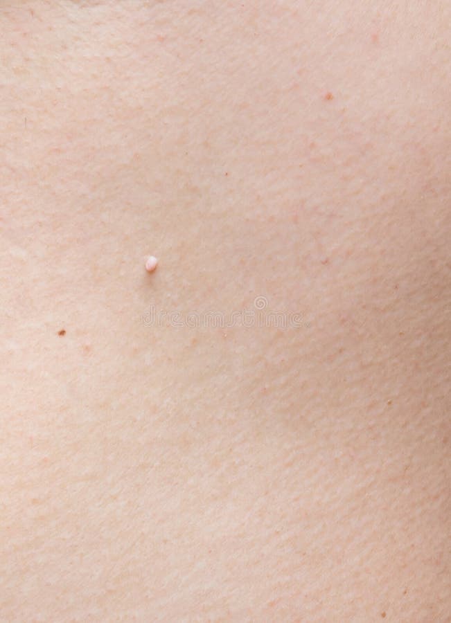 Pedunculated skin tag or acrochondon or soft fibroma. papilloma on human skin. Wart. Dermatological problem.mole on body , removal of moles nevus or warts stock images