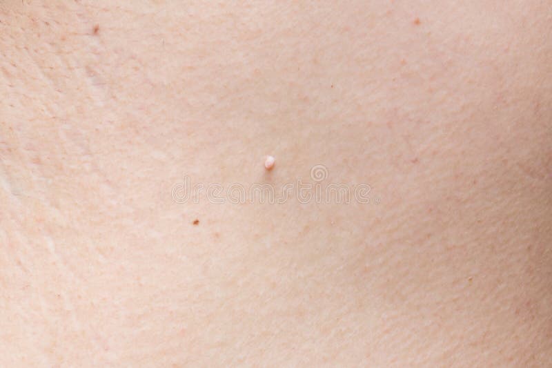 Pedunculated skin tag or acrochondon or soft fibroma. papilloma on human skin. Wart. Dermatological problem.mole on body , removal of moles nevus or warts stock photography