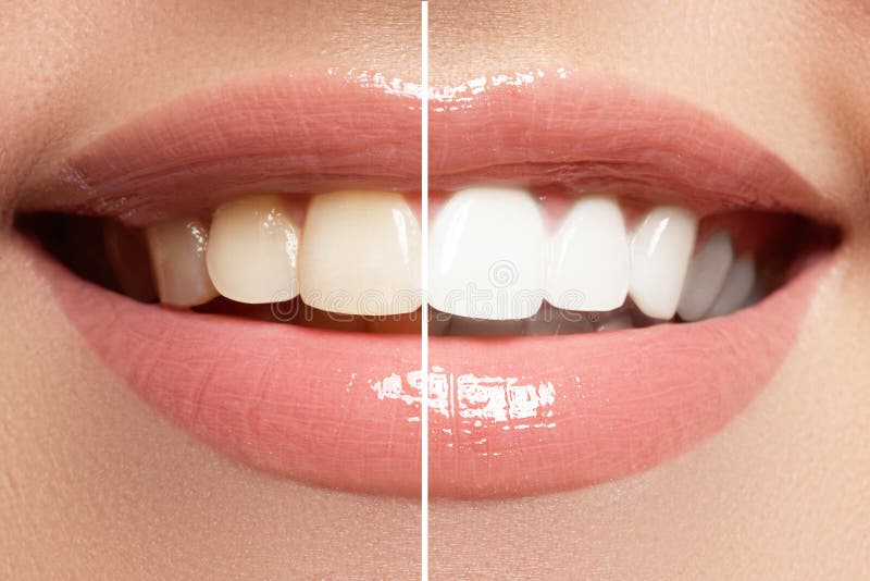 Perfect smile before and after bleaching. Dental care and whitening teeth royalty free stock images
