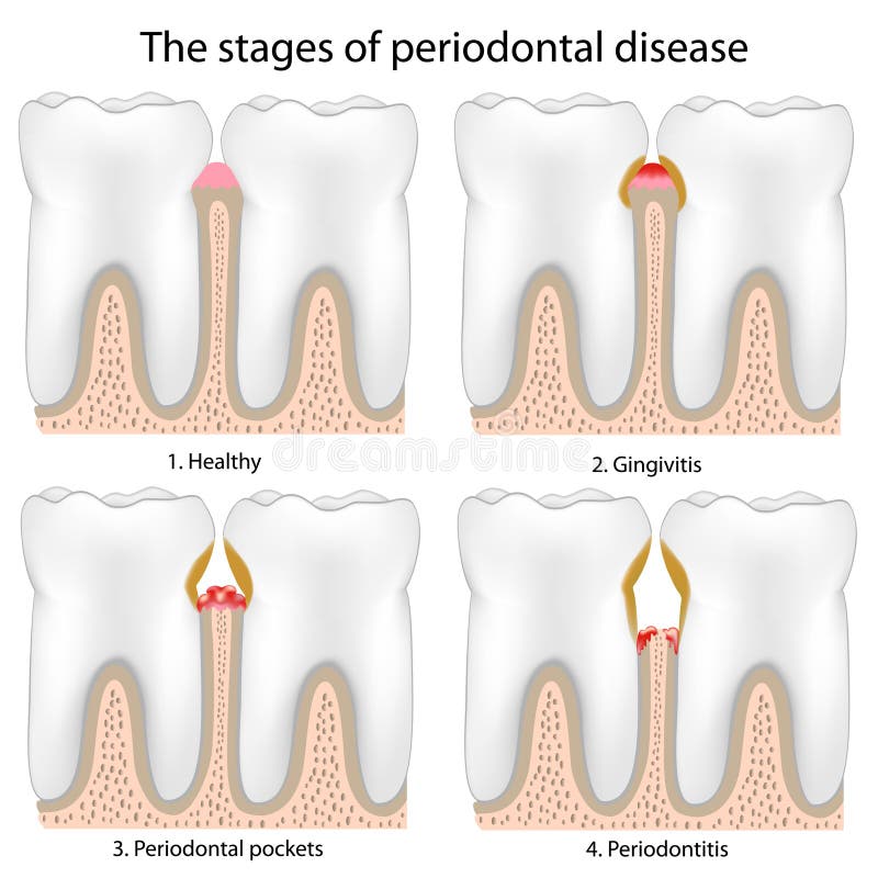 Periodontal Disease vector illustration