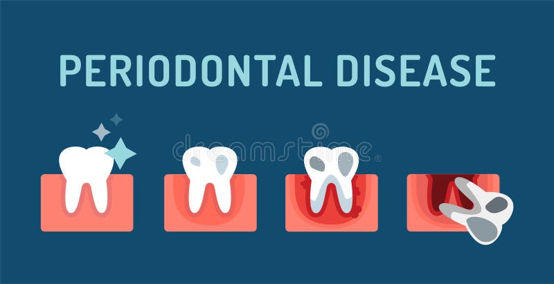 Periodontal disease stage steps vector. Illustration. Dental tooth problems vector concept. Toothache, tooth dead, bad tooth care. Doctors dentists professional royalty free illustration