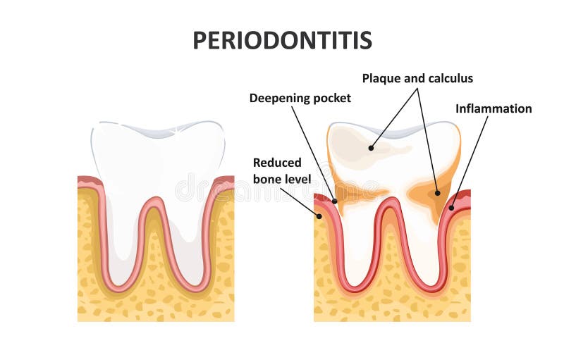 Periodontitis, dental disease. Inflammation of the gums stock illustration