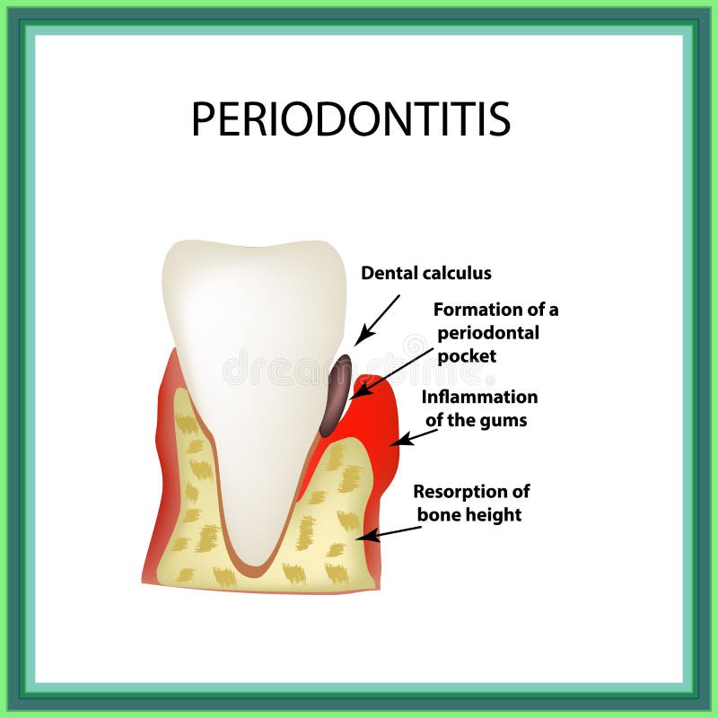 Periodontitis. dental disease. Inflammation of the gums and the. Tooth stone. Infographics. Vector illustration on isolated background royalty free illustration
