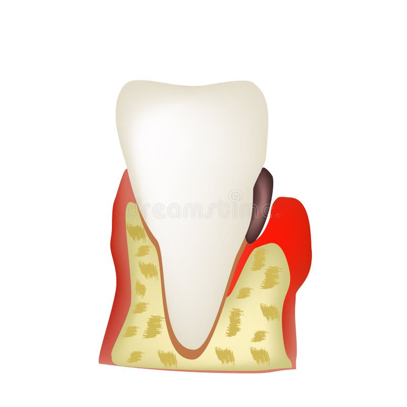 Periodontitis. dental disease. Inflammation of the gums and the. Tooth stone. Infographics. Vector illustration on isolated background vector illustration