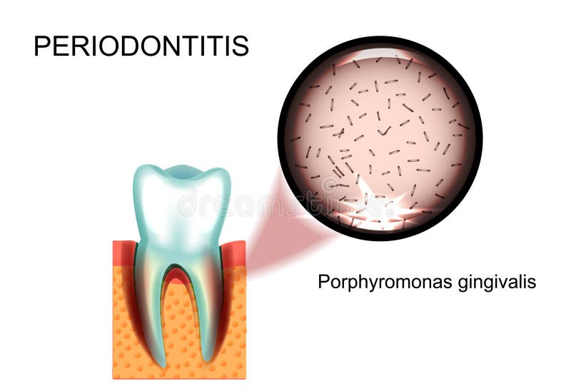 Periodontitis. Porphyromonas gingivalis royalty free illustration