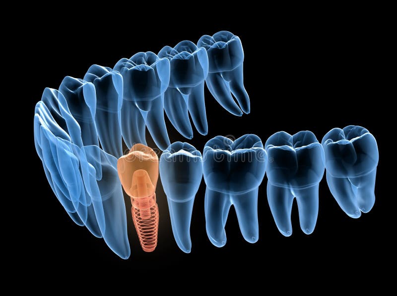 Premolar tooth recovery with implant, x-ray view. Medically accurate 3D illustration of human teeth and dentures vector illustration