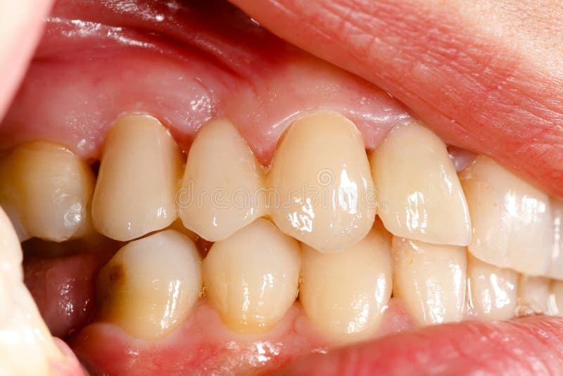 Pressed ceramic teeth in oral cavity royalty free stock photo