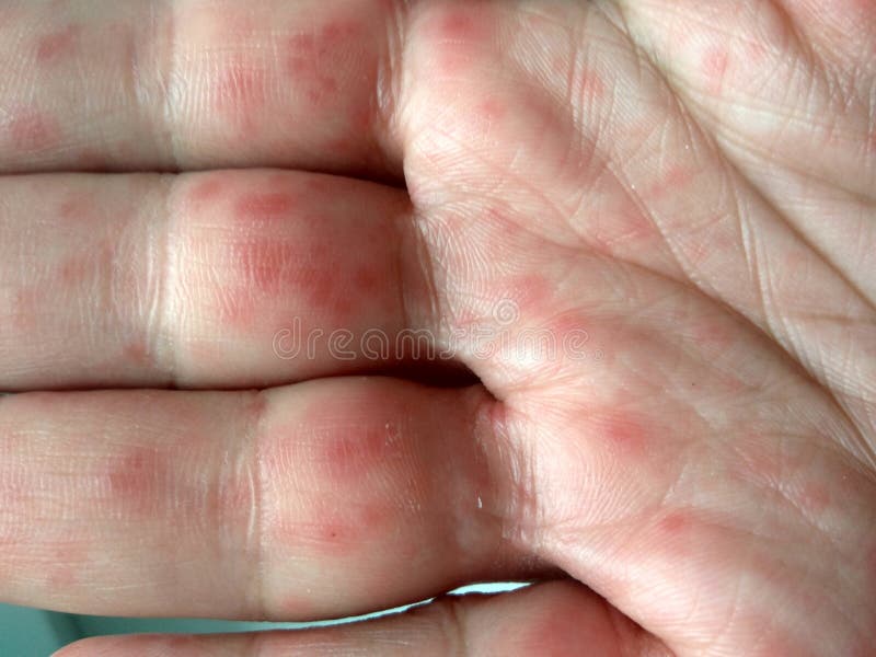 Realistic Coxsackie virus rash on hands. Coxsackievirus Coxsackie virus symptoms. Hands with rash. Red sports on the hand, palm and fingers stock photos