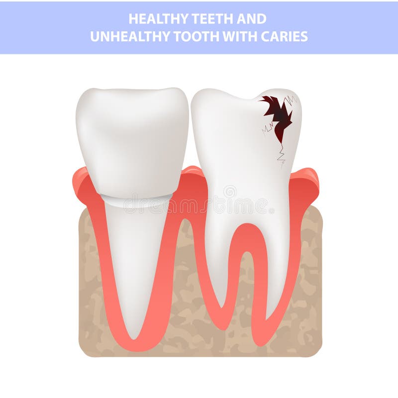 Realistic teeth, healthy teeth and caries, gum cross section, vector illustration. Realistic teeth, healthy teeth and caries, gum cross section, vector stock illustration