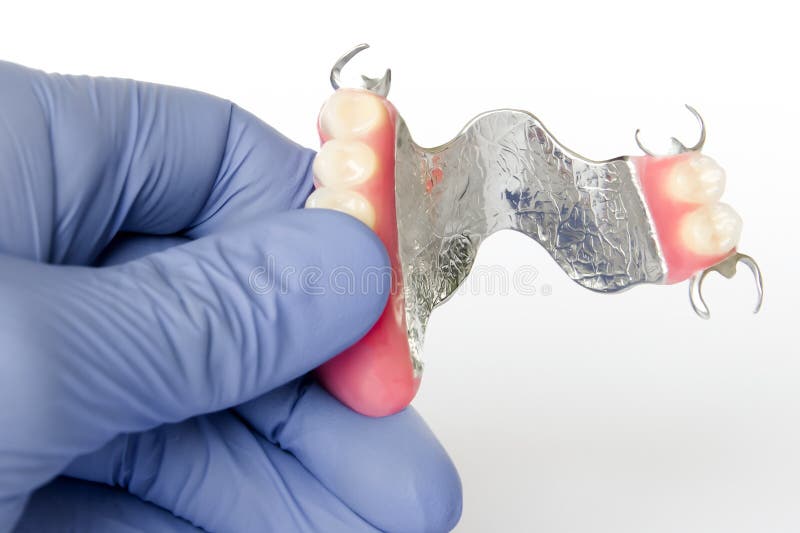 Partial removable clasp prosthesis on the upper jaw stock photography
