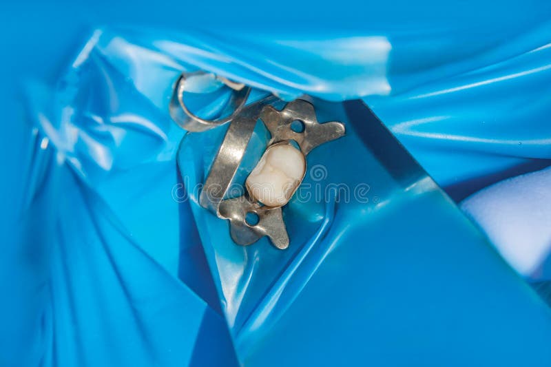Restoration of the molar of a human tooth with filling material. The concept of aesthetic restorative dentistry in a dental clinic stock photos