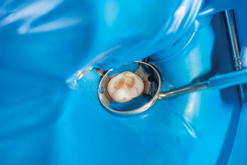 Restoration of the molar of a human tooth with filling material. The concept of aesthetic restorative dentistry in a dental clinic stock photos